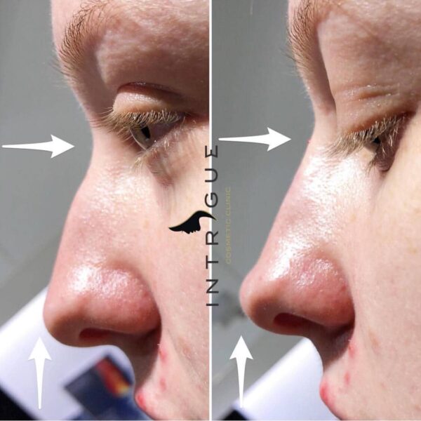 Treatment Results - Intrigue Cosmetic Clinic