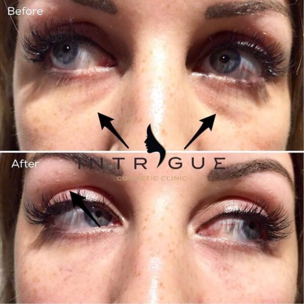 Treatment Results - Intrigue Cosmetic Clinic