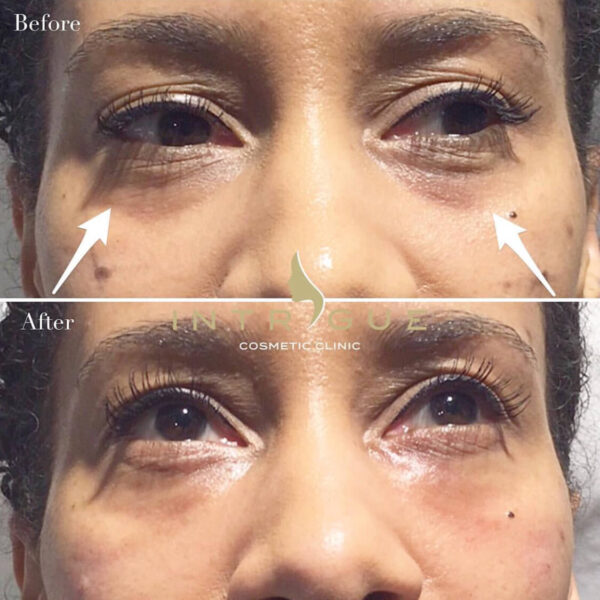 Treatment Results - Intrigue Cosmetic Clinic