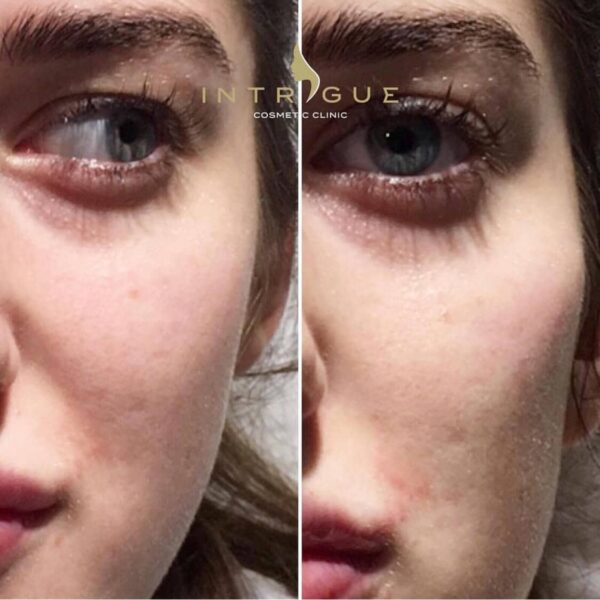 Treatment Results - Intrigue Cosmetic Clinic