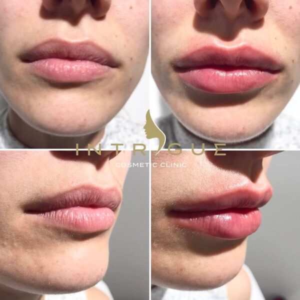 Treatment Results - Intrigue Cosmetic Clinic