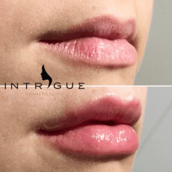Treatment Results - Intrigue Cosmetic Clinic