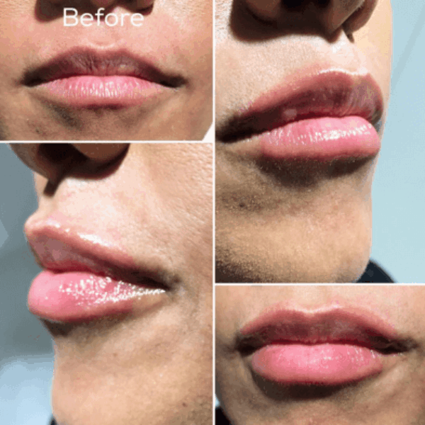 Treatment Results - Intrigue Cosmetic Clinic
