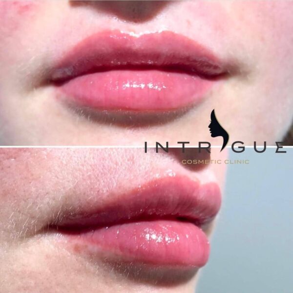 Treatment Results - Intrigue Cosmetic Clinic