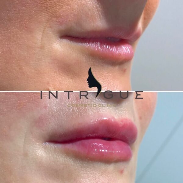 Treatment Results - Intrigue Cosmetic Clinic