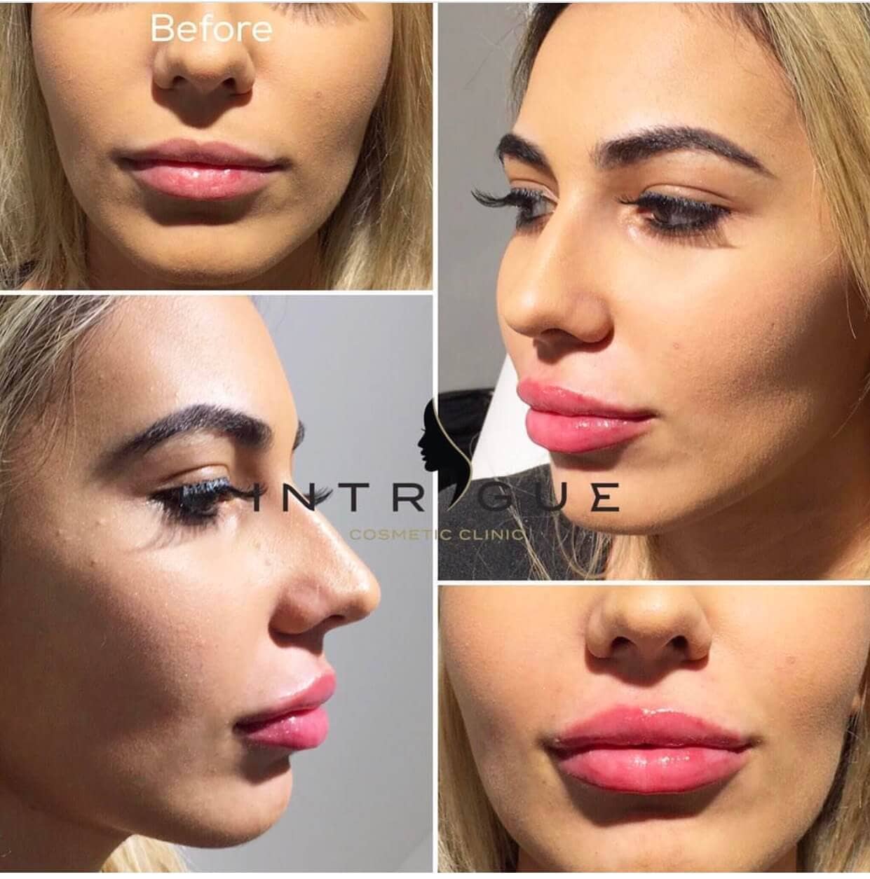1ml Cheek Fillers Before And After  Before And After