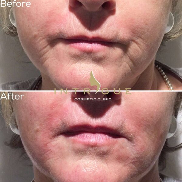 Treatment Results - Intrigue Cosmetic Clinic