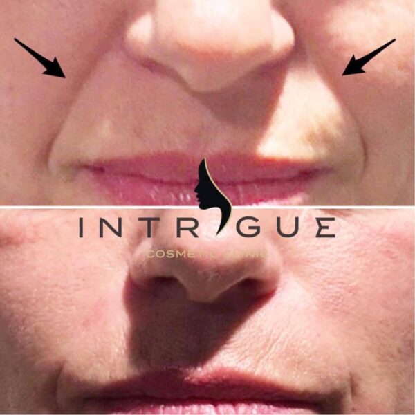 Treatment Results - Intrigue Cosmetic Clinic
