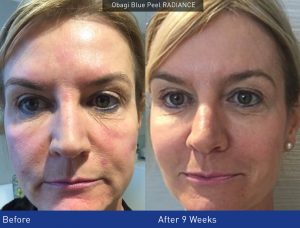 Blue Peel Radiance – Before & after Photo