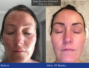 Obagi Nu-Derm – Before & after Photo