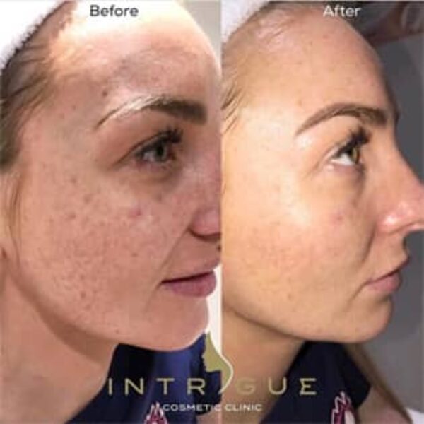 Treatment Results - Intrigue Cosmetic Clinic