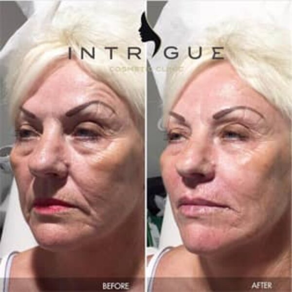 Treatment Results - Intrigue Cosmetic Clinic