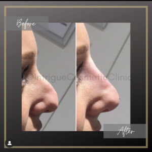 Example Of Liquid Rhinoplasty By Amish Patel At Intrigue Cosmetic Clinic
