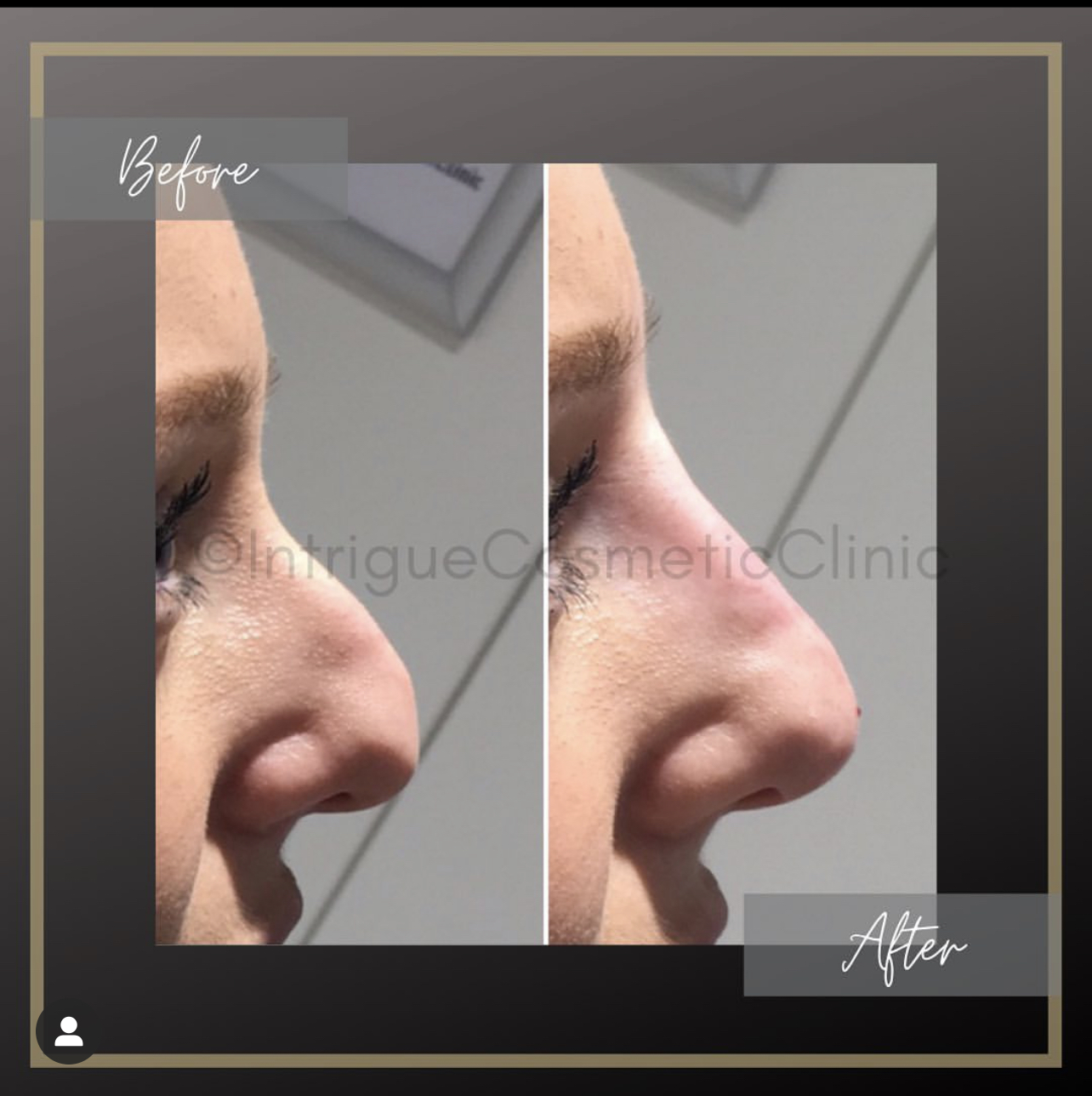 How a NonSurgical Nose Job Can Transform Your Appearance Intrigue Clinic