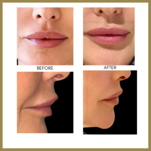 An Intrigue Cosmetic Clinic client before and after a lip flip aesthetics treatment.