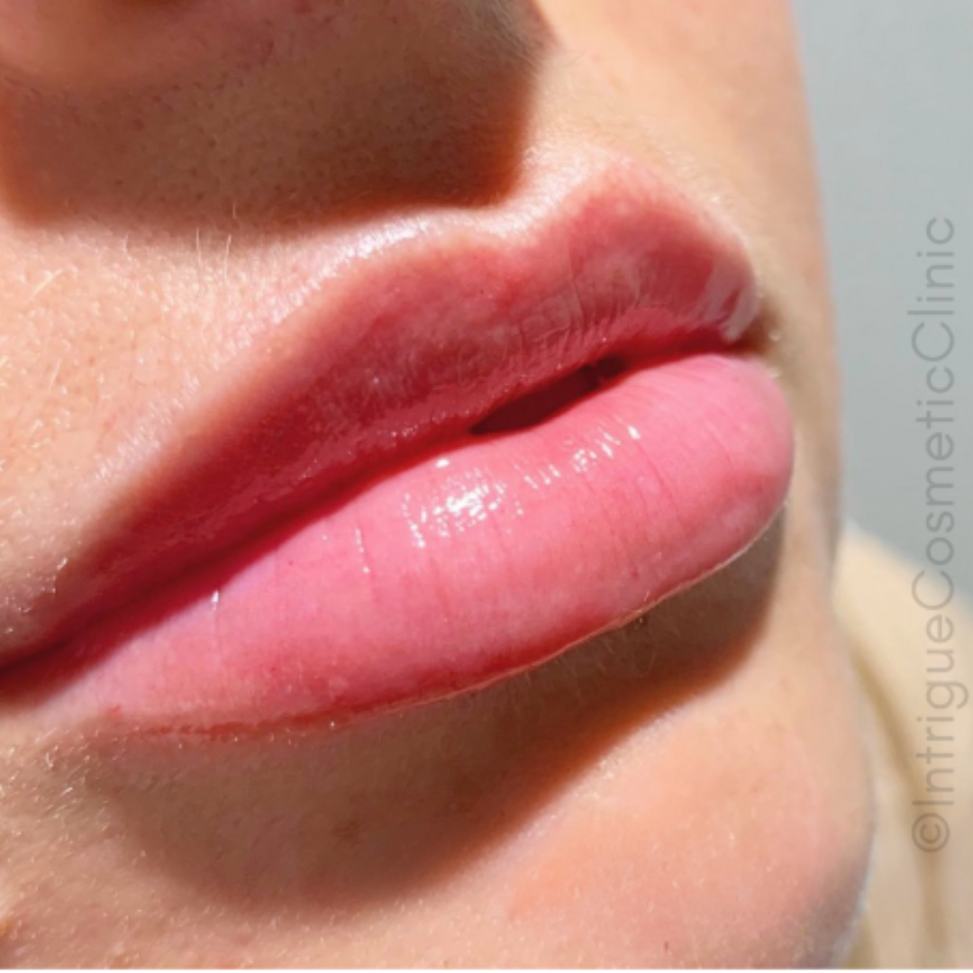 Beautiful results post lip filler at Intrigue Cosmetic Clinic, with client following advice on what not to do after lip fillers