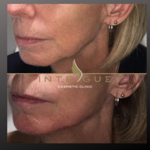 Real life client example before and after jawline filler showing improved contour of the jawline. 