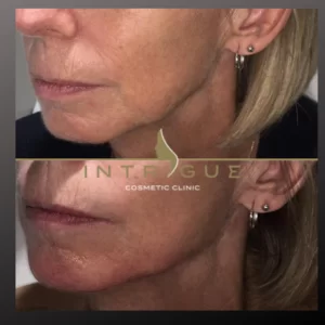 Real life client example before and after jawline filler showing improved contour of the jawline. 