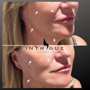 Woman showing a liquid face lift - before and after images showing a more youthful appearance without surgery.