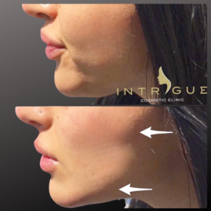 A combination of cheek and jawline filler give this client a sharper jawline silhouette.