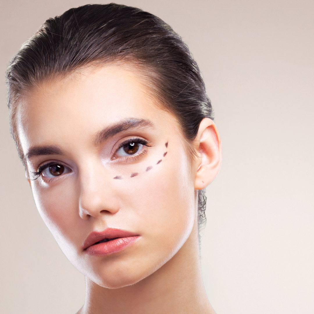 Woman concerned about under-eye shadowing and hollowing and considering tear trough filler with an aesthetics practitioner.