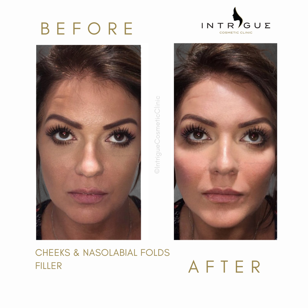 Cheek fillers at Intrigue Cosmetic Clinic, Gravesend Kent 