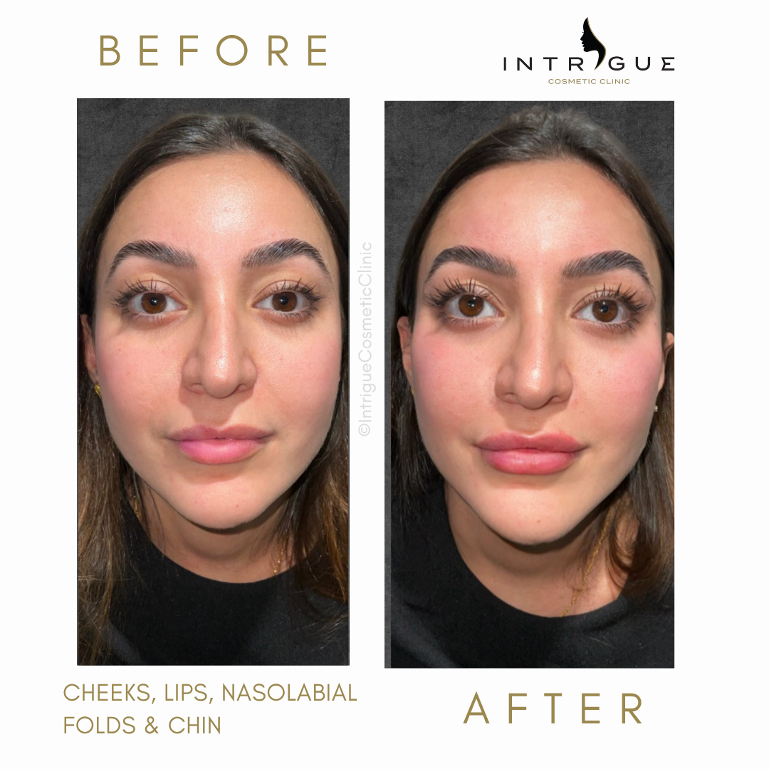 Woman before and after having had cheek fillers at Intrigue Cosmetic Clinic in Gravesend 