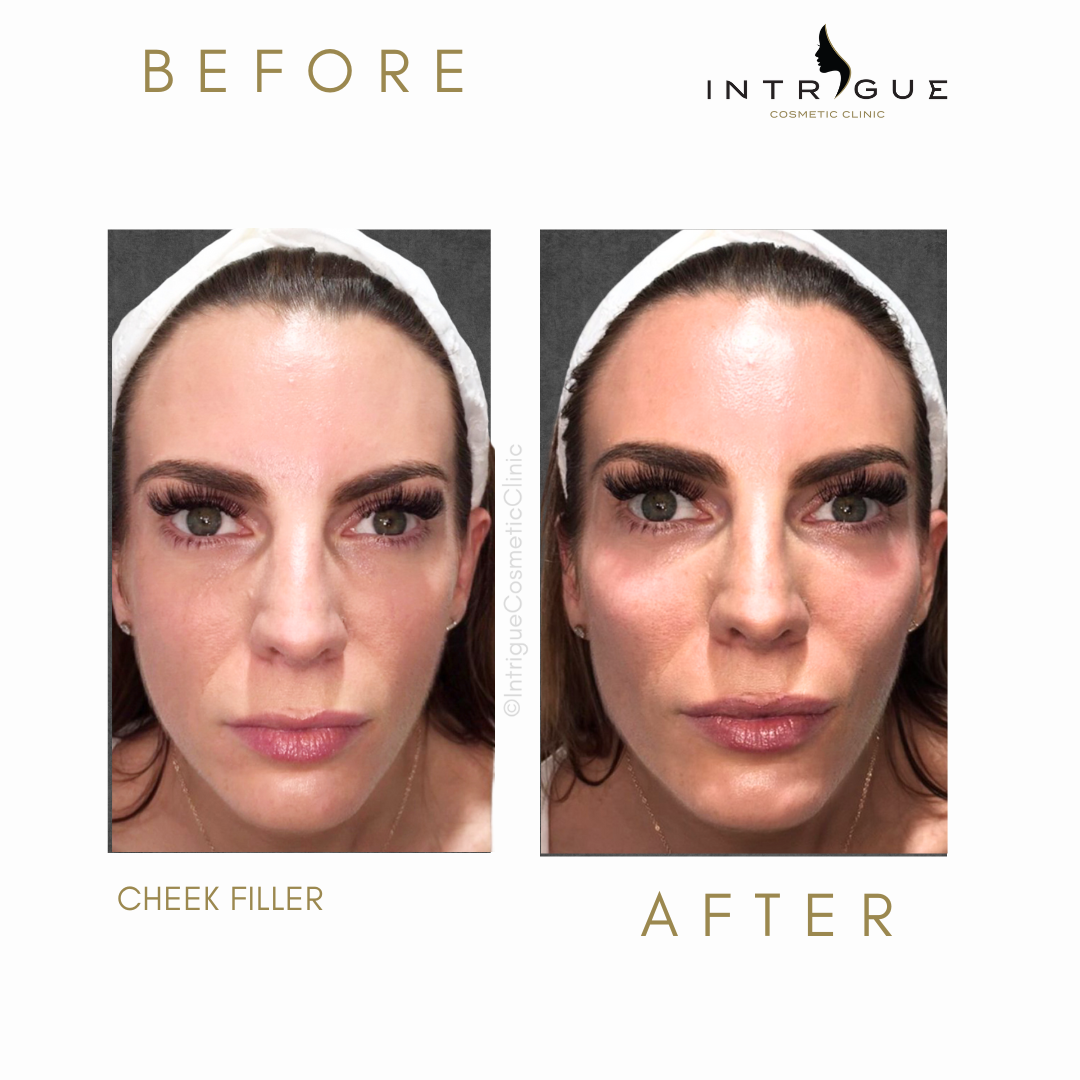 Before and after cheek fillers at Intrigue Cosmetic Cinic, Gravesend, Kent.