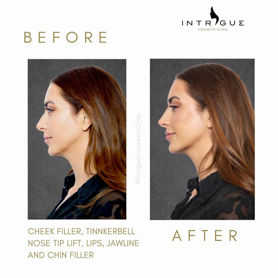 Cheek fillers at Intrigue Cosmetic Clinic, Gravesend, Kent.